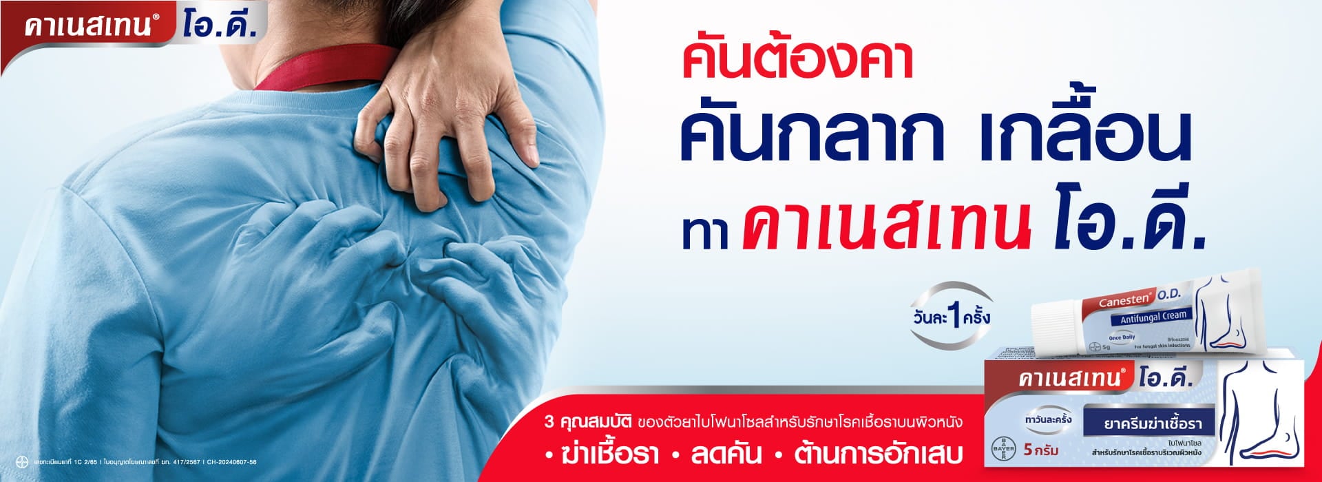 โรคผิวหนังจากเชื้อรา ต้องคาเนสเทน โอ.ดี. 1